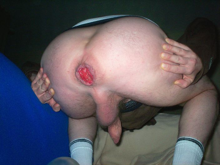 bum ass butt man hole anal rosebutt prolapse  pics